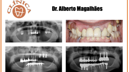 Casos clínicos de implantes curtos