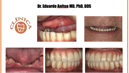 Implantes curtos e estreitos para o retratamento de um caso de peri-implantite com defeitos ósseos extensos na mandíbula. Caso clínico