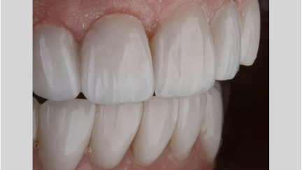 As proteínas no esmalte dentário oferecem uma janela para o bem-estar humano