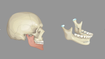 Andaimes impressos em 3D utilisando design personalizado para reconstruir ossos da mandíbula