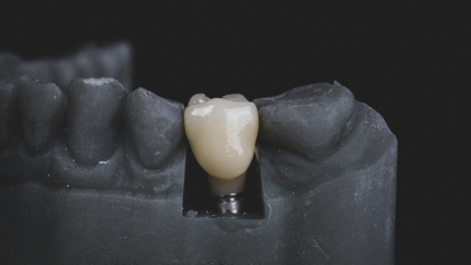 Estudo revela que Implantes dentários continuam funcionais após 40 anos