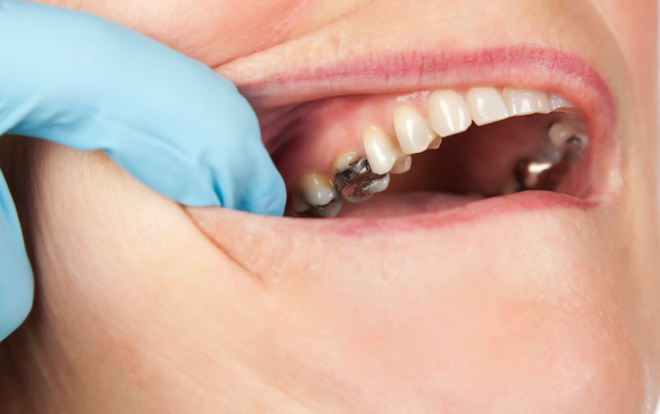 Divulgada nova diretriz da ADA para o tratamento da cárie dentária