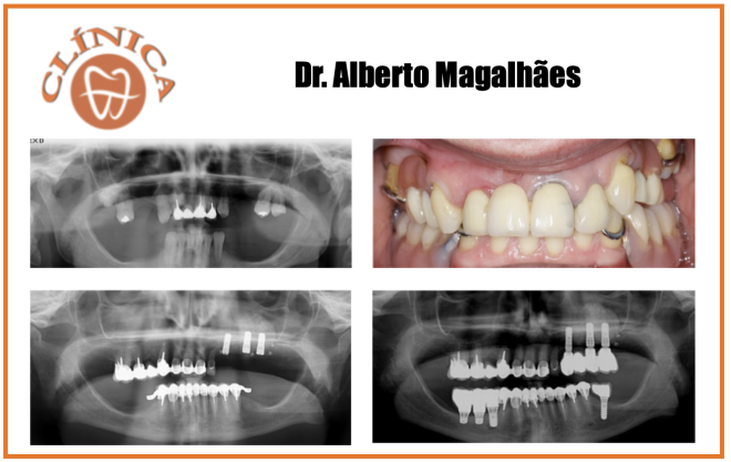 Casos clínicos de implantes curtos