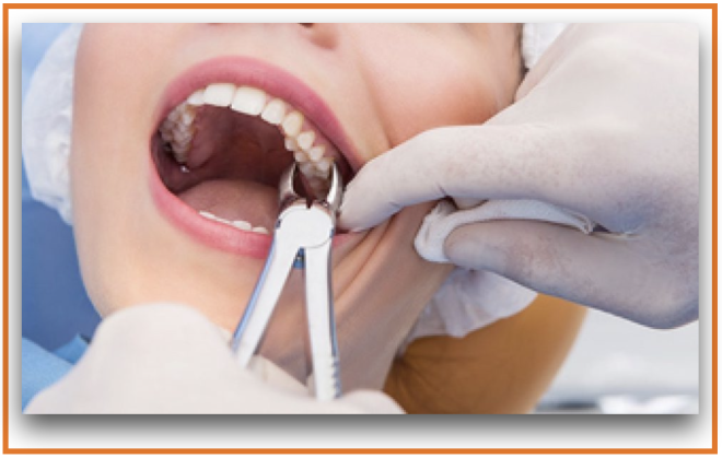 Estudos mostram forte ligação entre a perda de dente e a doença inflamatória intestinal